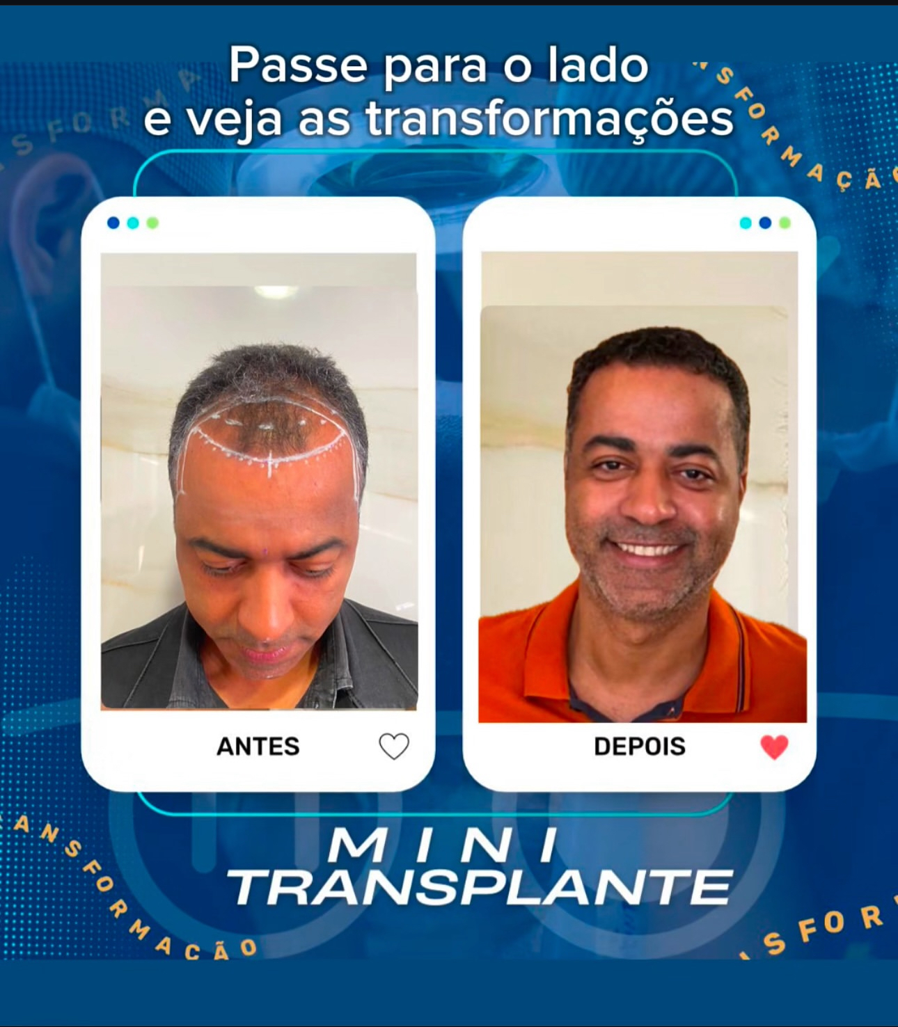 Paciente Antes do MINI Transplante Capilar 1