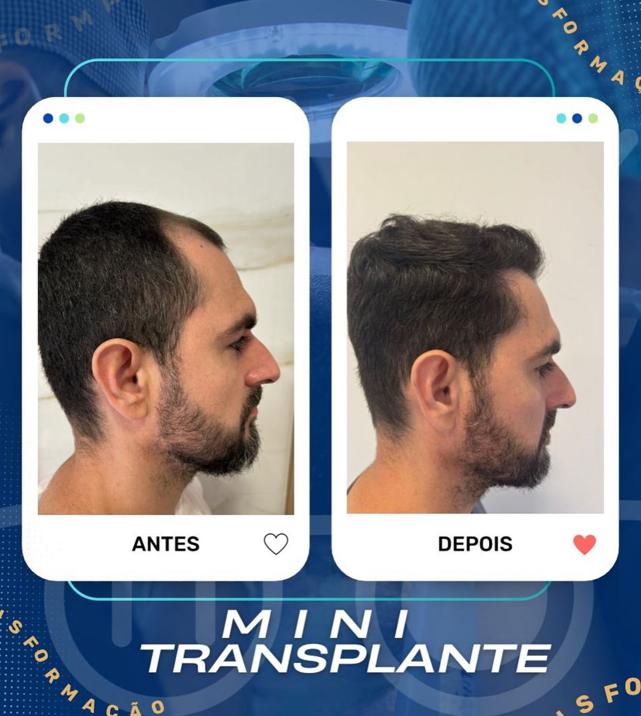 Paciente Depois do MINI Transplante Capilar 1