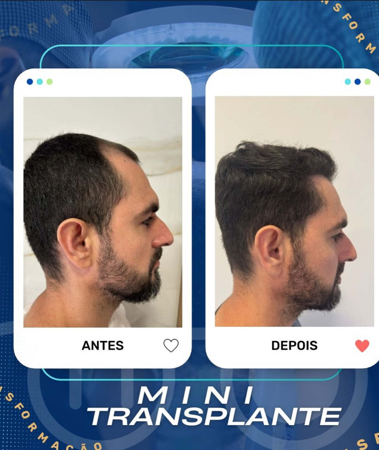 Paciente Antes do MINI Transplante Capilar 2