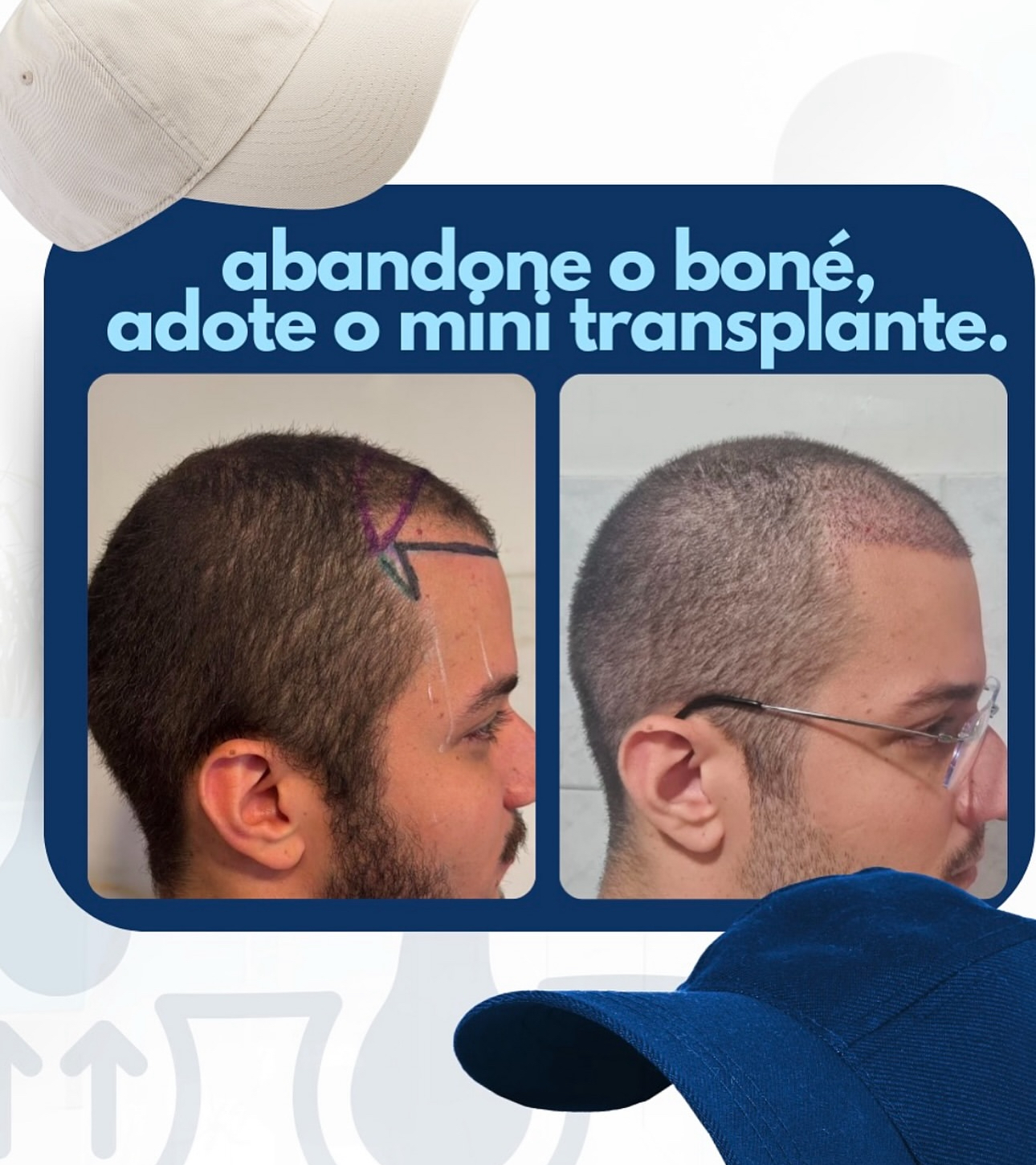 Paciente Depois do MINI Transplante Capilar 2